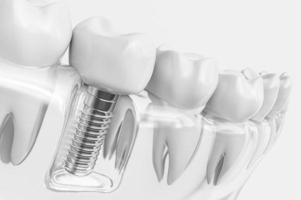 IMPLANTS DENTAIRES