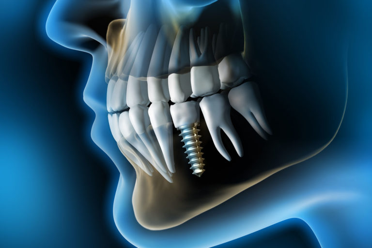 article blog implant dentaire boulogne billancourt