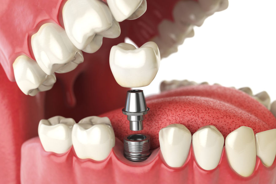 implant dentaire Boulogne Billancourt saint cloud 92