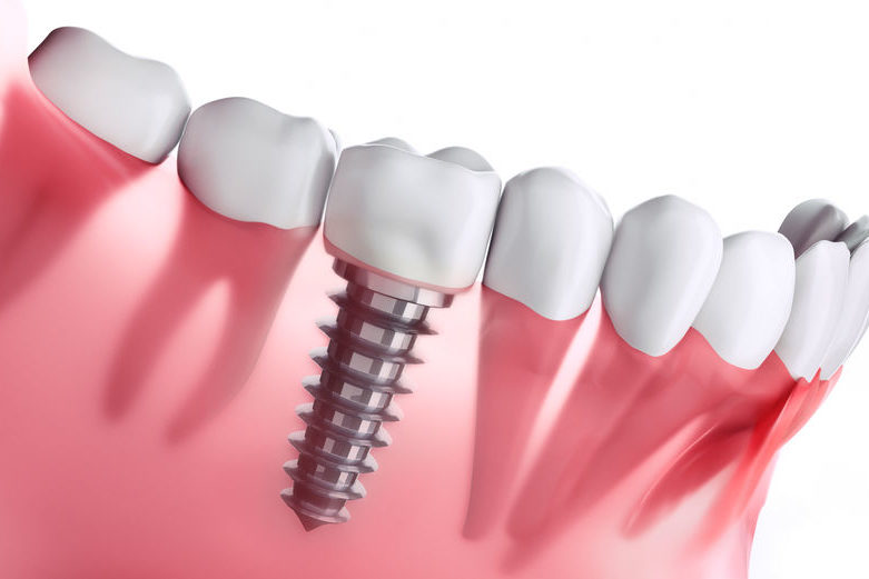 implant dentaire boulogne billancourt